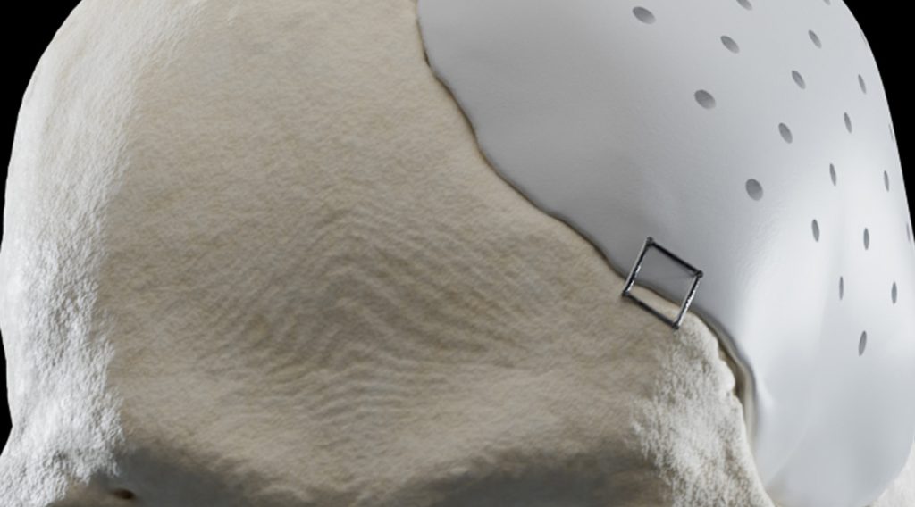 Ein Schädel mit einem Implantat auf der linken Schädelseite