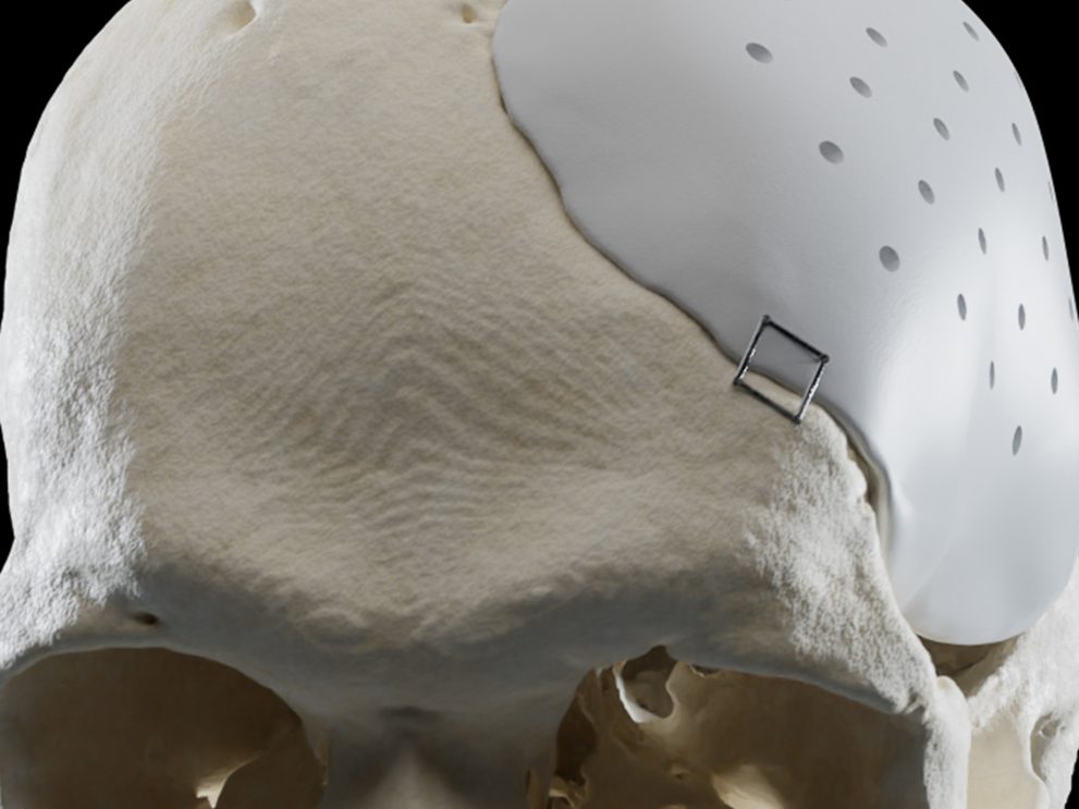 Ein Schädel mit einem Implantat auf der linken Schädelseite