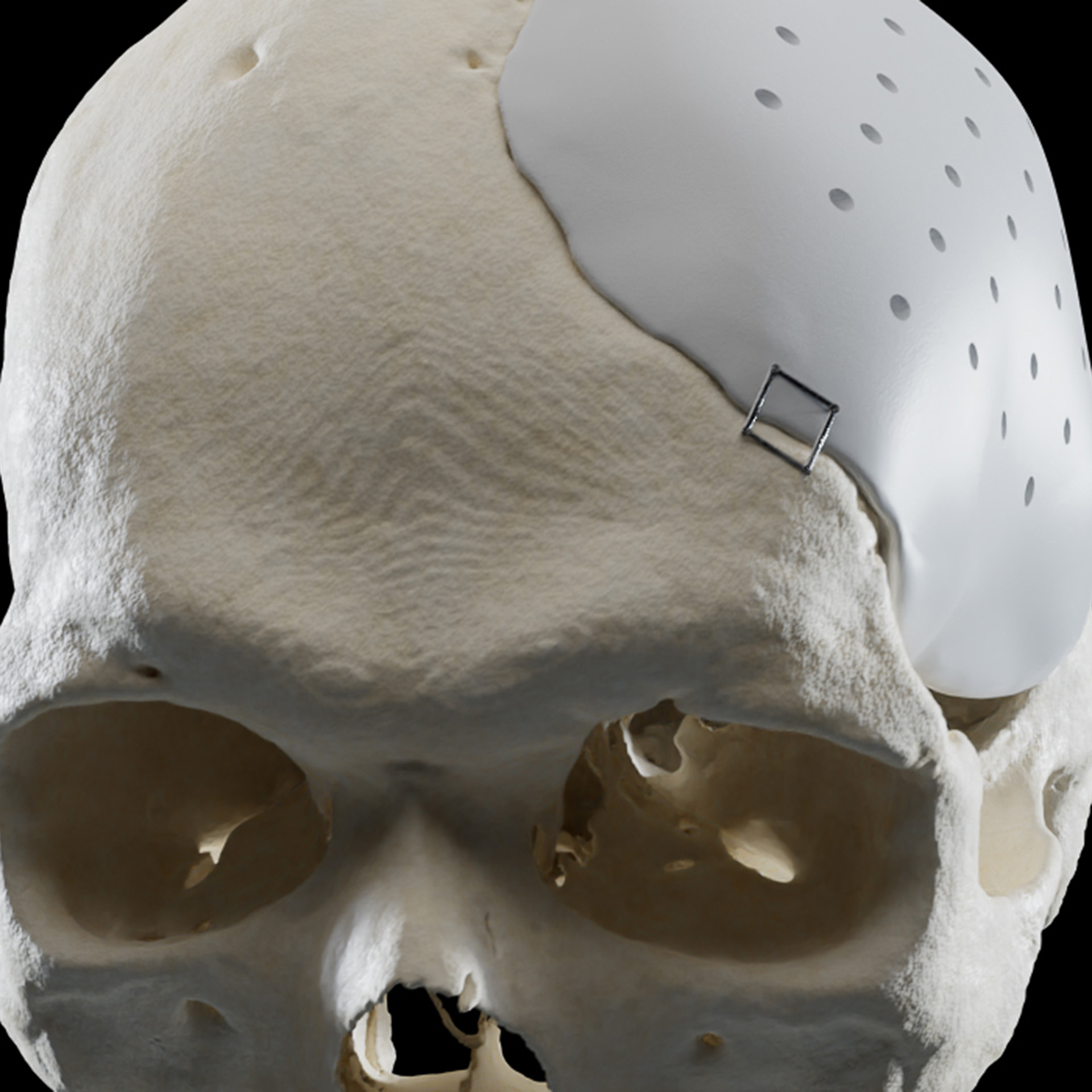 Massgefertigte Implantate fr chirurgische Perfektion - FHNW eMagazin