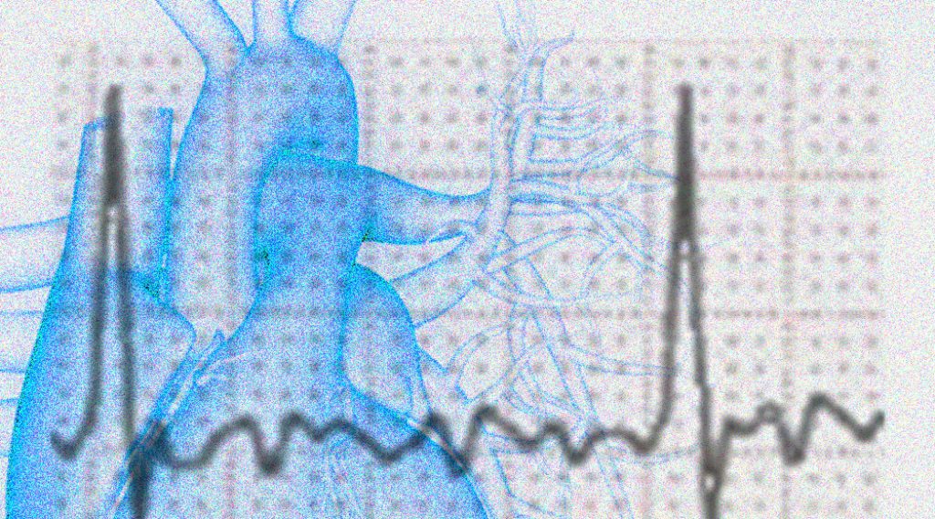 Bildmontage einer Zeichnung eines menschlichen Herz im Hintergrund und davor der Graph eines EKG