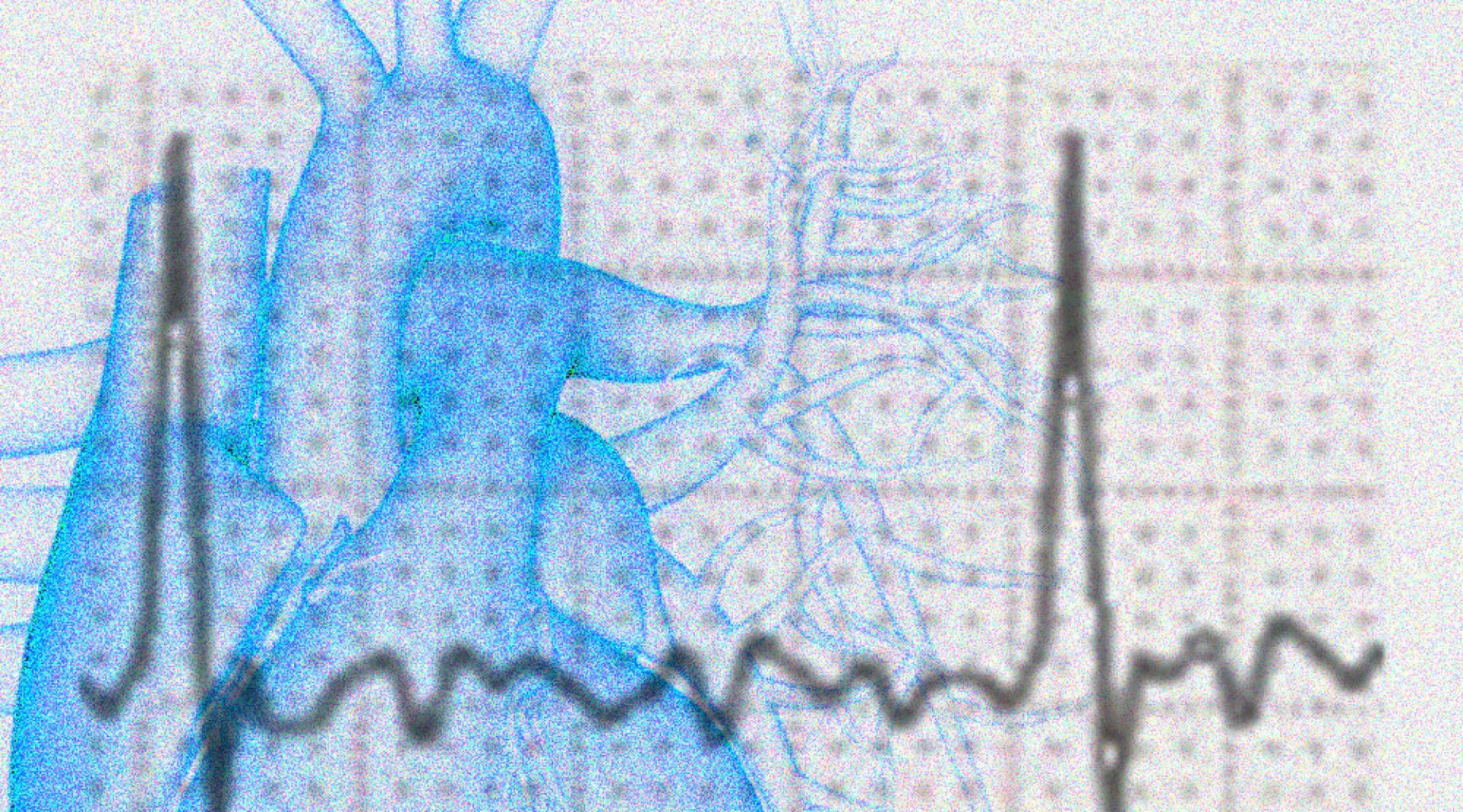 Bildmontage einer Zeichnung eines menschlichen Herz im Hintergrund und davor der Graph eines EKG