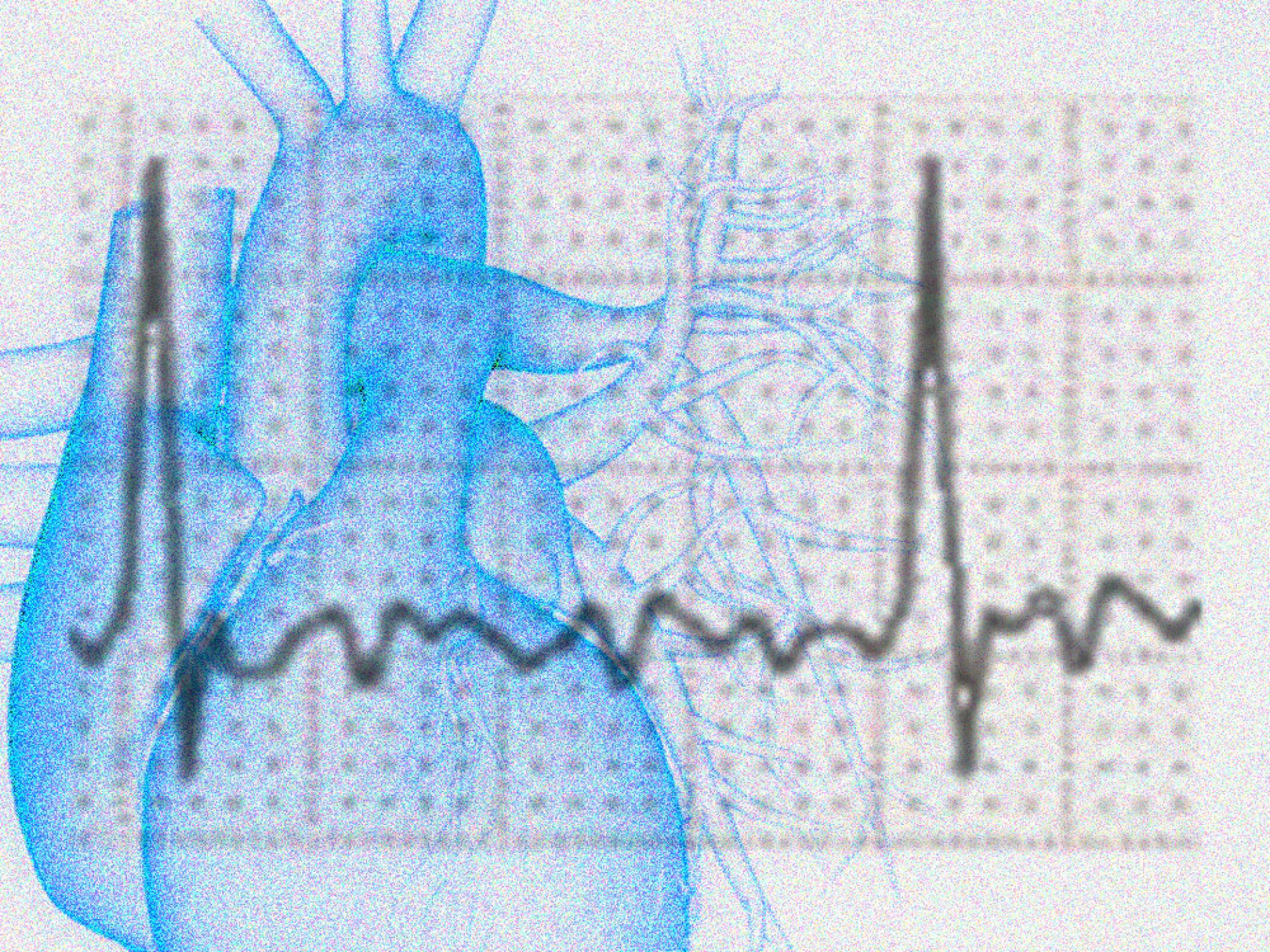 Bildmontage einer Zeichnung eines menschlichen Herz im Hintergrund und davor der Graph eines EKG
