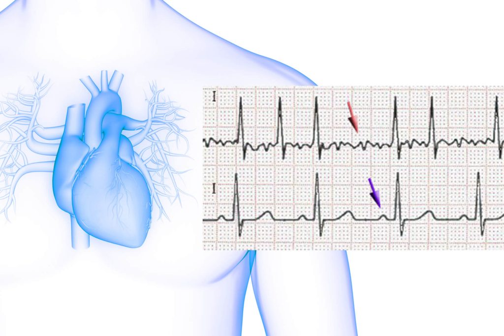 Vergleich zweier EKG-Graphen